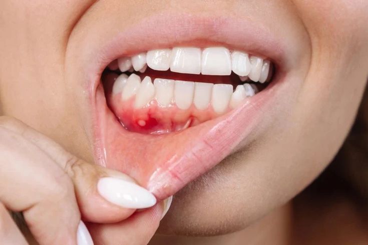 encia inflamda endodoncia en Medellín endodoncia en Medellín,dolor de muela,tratamiento dental,Dolor intenso,infección dental