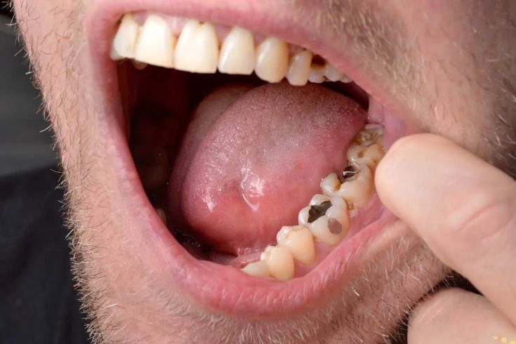 oscurecimiento dental endodoncia en Medellín endodoncia en Medellín,dolor de muela,tratamiento dental,Dolor intenso,infección dental